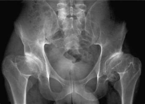 Spondyloepiphyseal Dysplasia Dwarfism