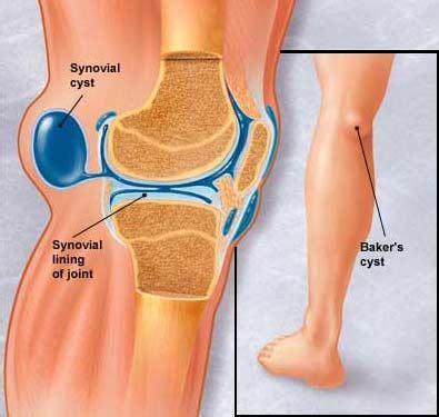 Baker's Cyst - Lump Behind the Knee by Dr Kevin Yip | Singapore Sports ...