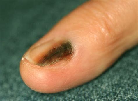 nail bed melanoma - pictures, photos