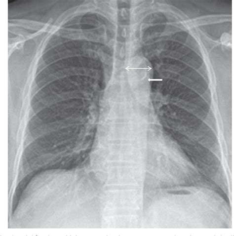 Table 1 from The clinical significance of aortic calcification in chest ...