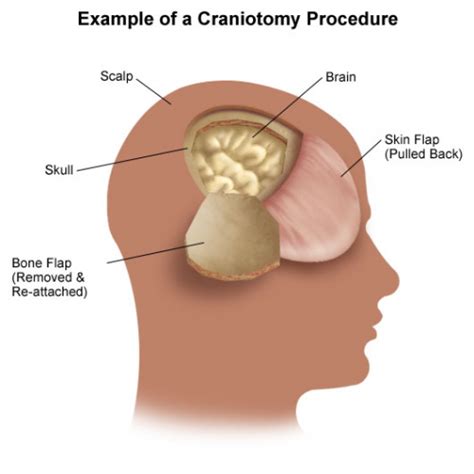 Best Craniotomy Treatments Hospital & Doctors in India | HBG Medical assistance