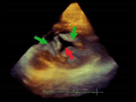 Cleft Mitral Valve Leaflet