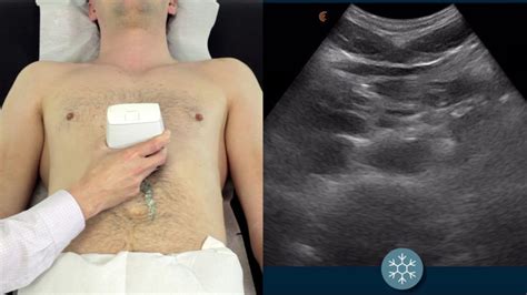 Using Ultrasound to Assess for an Abdominal Aortic Aneurysm | Clarius