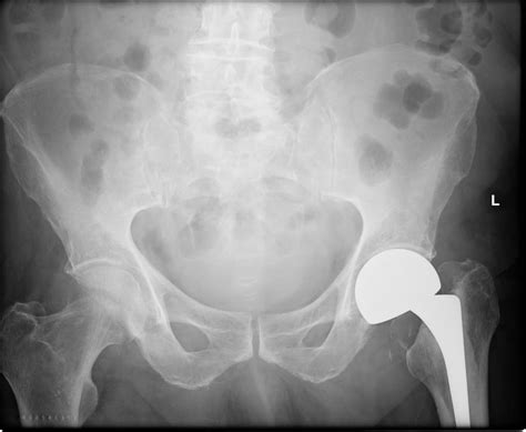 Hemiarthroplasty vs Total Hip Replacement - Sutured