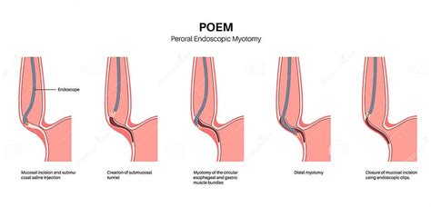 POEM medical poster stock illustration. Illustration of gastroscopy - 290186077