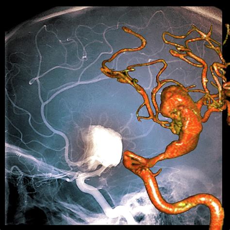 Cerebral Aneurysm #11 Photograph by Zephyr/science Photo Library - Pixels