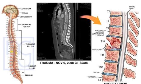 Fractured Neck Vertebrae Symptoms