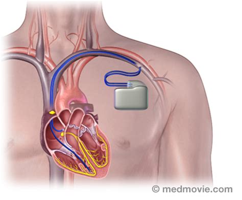 Pacemakers – Dual Chamber