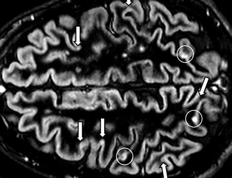 MS brain lesions: Pictures and prognosis