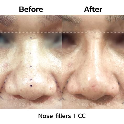 What are nose fillers? Advantages and precautions when injecting ...