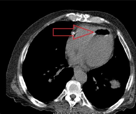 Cureus | Systemic Air Embolism Following Computed Tomography-Guided Lung Biopsy