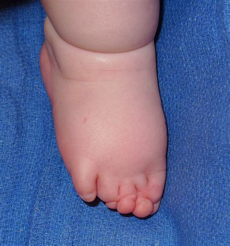 Amniotic Constriction Band | Congenital Hand and Arm Differences