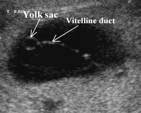 Vitelline Duct Ultrasound