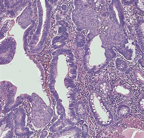 Thyroid Adenoma Histology