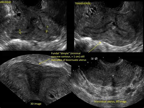 Congenital uterine anomalies: A resource of diagnostic images, Part 2 ...