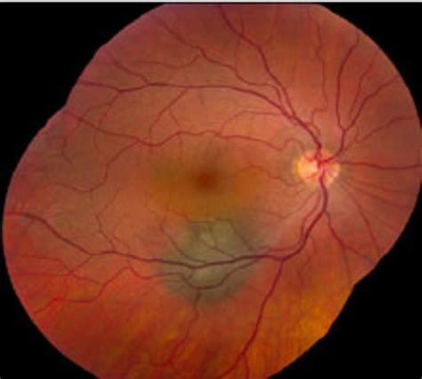 When To Treatment Of Choroidal Melanoma