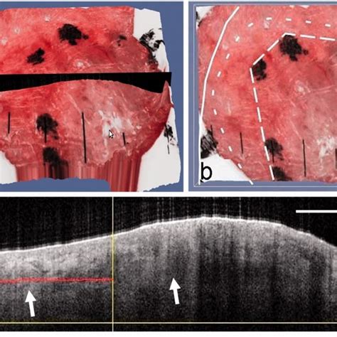 The clinical images of a nodular BCC from patient 3 before (a) and ...