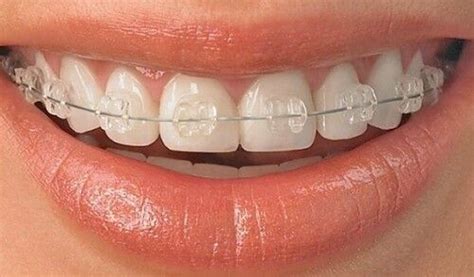 Pure Sapphire Bracket System, Prestige Dental Products