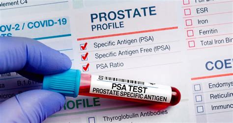 PSA Blood Test | Florida Center For Prostate Care - Jacksonville, Florida