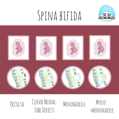 Fetal surgery for Spina bifida (Myelomeningocele ) - The Scrub Nurse