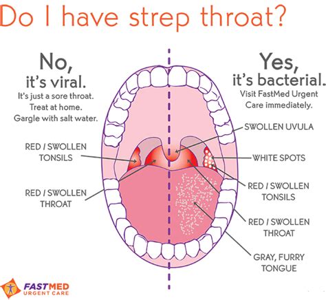 Strep Throat: What It Looks Like - FastMed