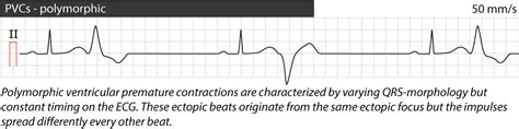 Premature ventricular contractions (premature ventricular complex ...