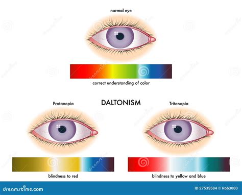 Daltonism Stock Images - Image: 27535584