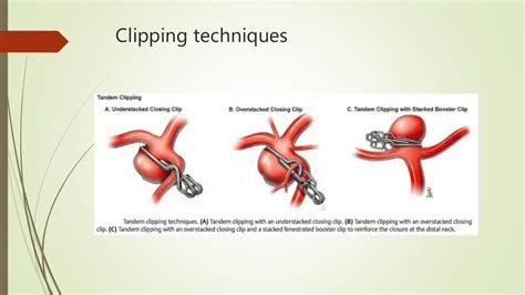 Aneurysm clips /clipology