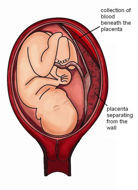 Placental Abruption - Pitter Patter