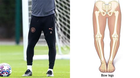 Why do footballers have bow legs | Causes explained in DETAILS