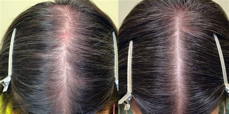 Topical Minoxidil (Females) Before & After Photos - Hair Restoration of the South - New Orleans, LA