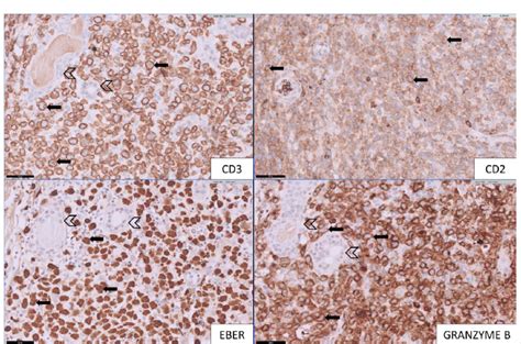 [Top left] Medium to large lymphomatous cells show cytoplasmic staining ...