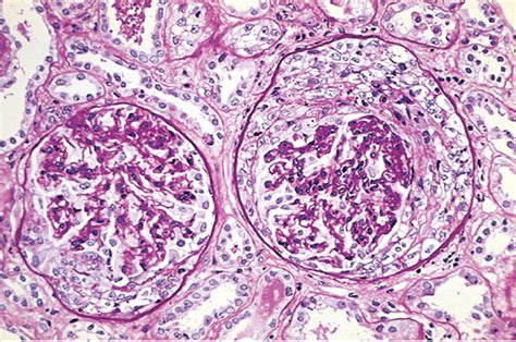 Rapidly Progressive Glomerulonephritis (RPGN). | Geoffrey E. Reed life