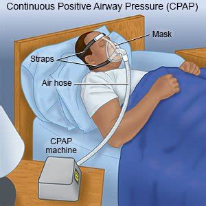 What is a CPAP Machine, Benefits, Usage Tips - Drugs.com