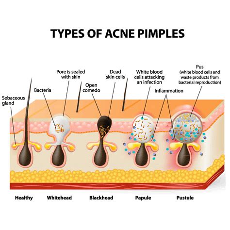 The Complexities Of Acne: A Comprehensive Guide - Best Skin Whitening Solutions – Brighten Your ...