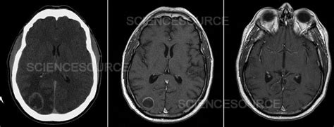 Photograph | Radiation therapy, MRI | Science Source Images