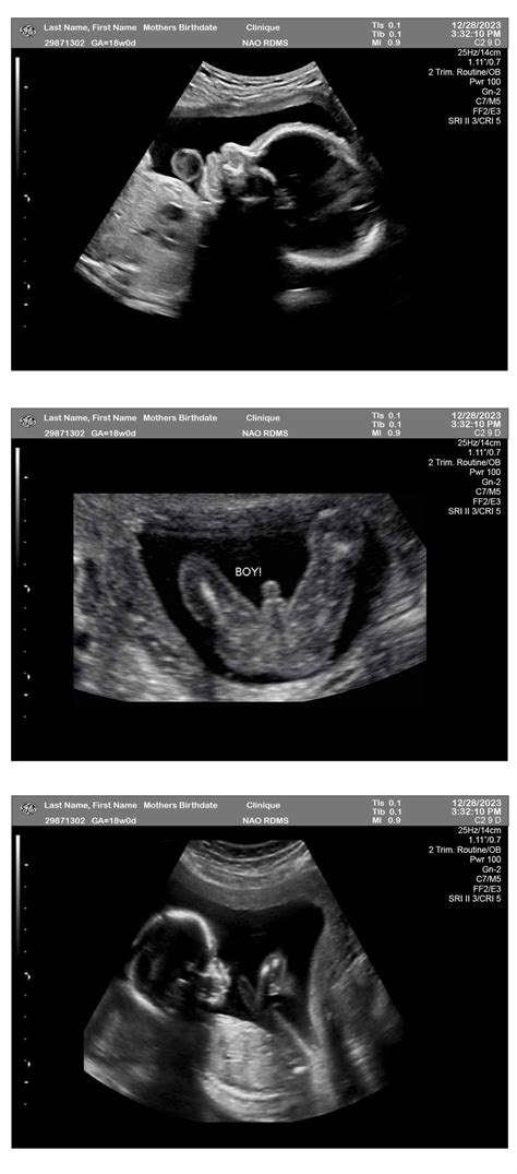 18 Weeks Ultrasound Boy 3-Fetuses - Ultrasounds