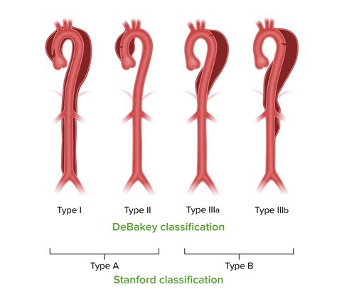 Thoracic Aortic Aneurysm Classification