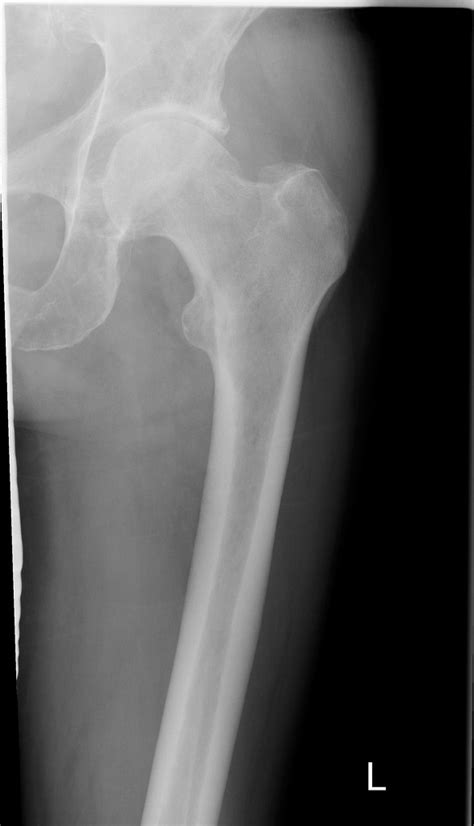 Femur Radiographs