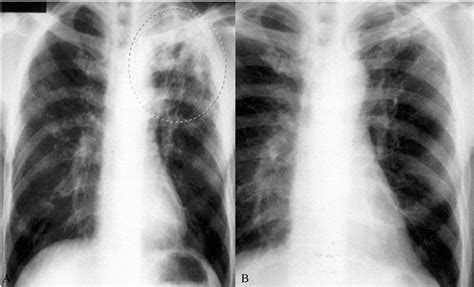 Pathophysiology of Tuberculosis | IntechOpen