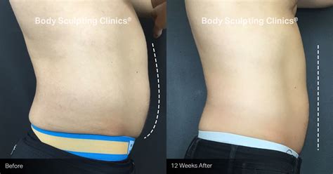 Before and After | Body Sculpting Clinics