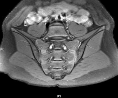 Frontiers | Effectiveness of tumor necrosis factor inhibitors in children with enthesitis ...