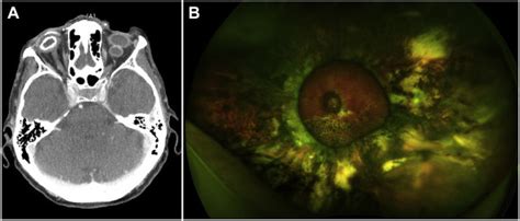 Major Scleral Buckle - Ophthalmology