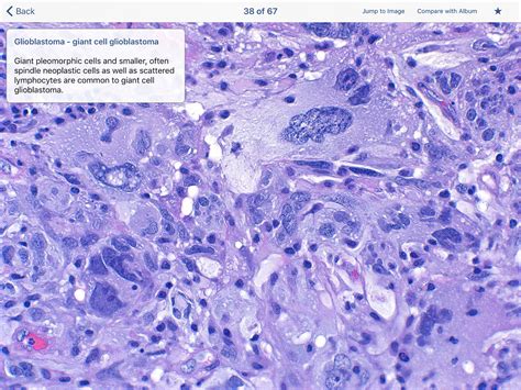 neuropathology blog: Screenshots of the surgical neuropathology volume ...