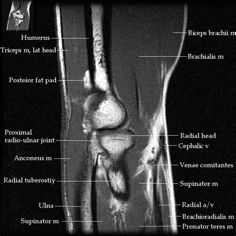 Elbow Anatomy Xray