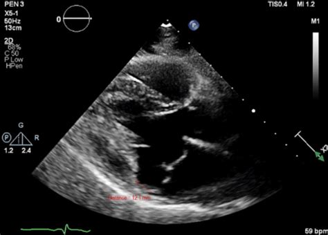 Mitral annular disjunction. Linear distance measured between the mitral... | Download Scientific ...