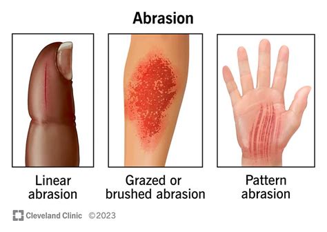 Abrasion (Scrape): How To Treat