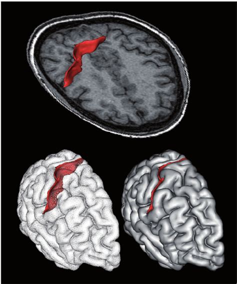 Three-dimensional reconstruction of the right central sulcus in one... | Download Scientific Diagram