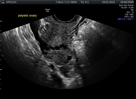 | polycystic ovaries scan | Diagnostic Ultrasound