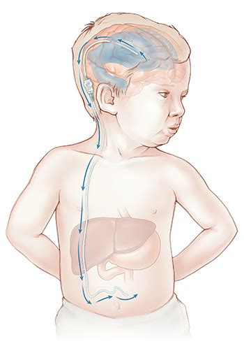 Hydrocephalus | Doernbecher Children's Hospital | OHSU
